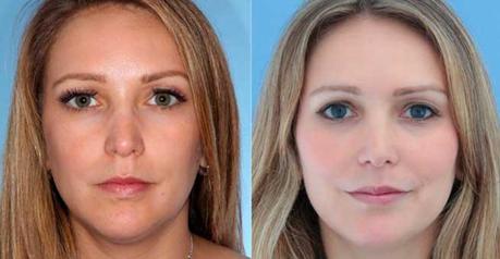Facial Implants to Enhance Your Facial Features Facial Implants Before & After
