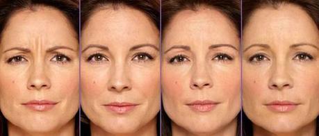 Before and After pictures of Xeomin Before and After pictures of Xeomin