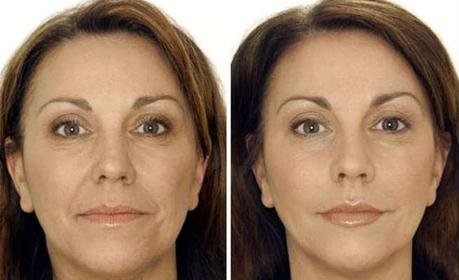 Botox - Before & After Botox - Before & After