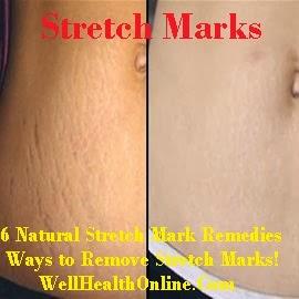 Natural Stretch Mark Remedies