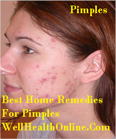 Best Home Remedies For Pimples