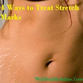 Ways to Treat Stretch Marks