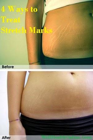 Ways to Treat Stretch Marks