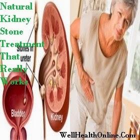 Natural Kidney Stone Treatment That Really Works