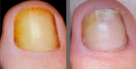 Learn All About the Laser Toenail Fungus Treatment laser-toe-nail-fungus-treatment-1