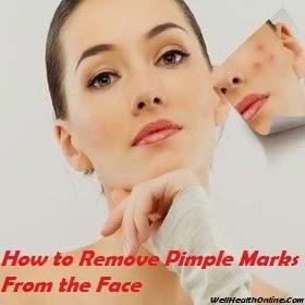 How to Remove Pimple Marks From the Face