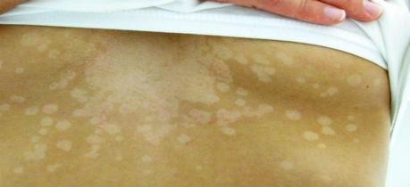 tinea versicolor remedies infection natural symptoms paperblog main