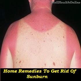 Home Remedies to Get Rid of Sunburn