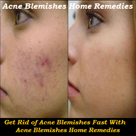 Acne Blemishes Home Remedies