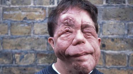 Adam Pearson. Glazer approached him to feature in the film as he was resistant to using prosthetics to show the condition. 