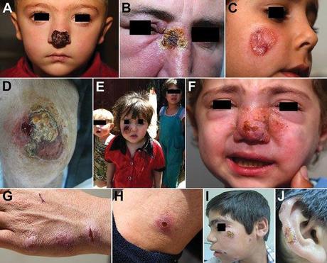 Patterns of leishmaniasis among Syrian refugees in Lebanon, 2012A,B) Lesions impinging and possibly hindering the function of vital sensory organs, including the nose and eyesC,D) Lesions ></div>5 cm.E,F) Lesions disfiguring the faceG,H) Special forms of cutaneous leishmaniasis; shown here is a patient with spread and satellite lesions on the hand and armI,J) Patient with 15 lesions.