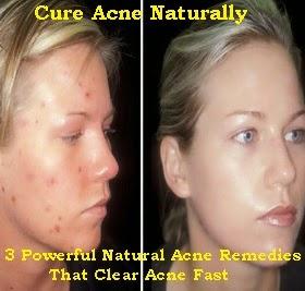 Powerful Natural Acne Remedies