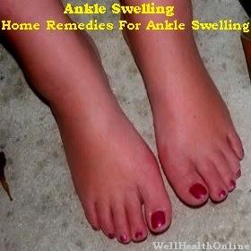 Home Remedies for Ankle Swelling