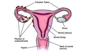 endometriosis-womb-diagram