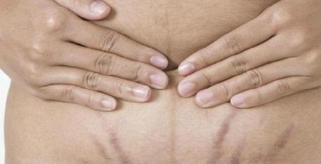 Get Rid of Stretch Marks by Consuming the Right Foods