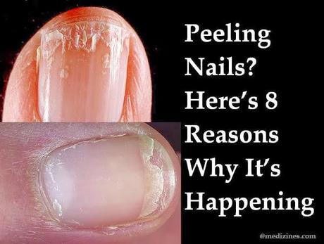 fingernails cracking #10