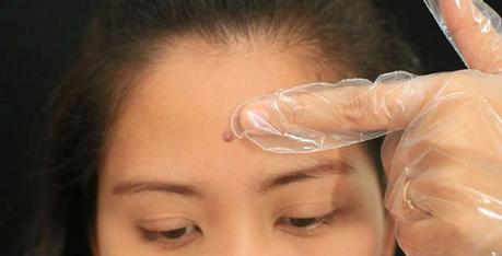 How to Extract a Pimple at Home Safely