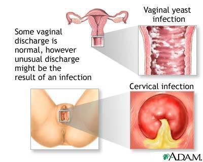 A Look At Vaginal Discharge: Normal Or Not ?