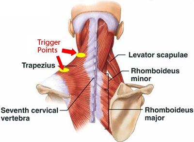 trigger-points