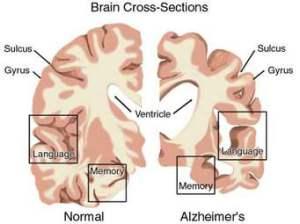 BRAIN image with Alzheimer's