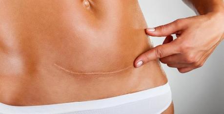 Get a Flat Tummy after C-Section