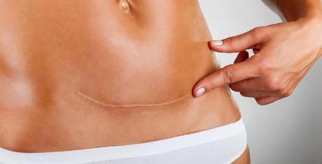 Get a Flat Tummy after C-Section Get a Flat Tummy after C-Section