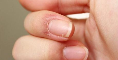 Peeling Fingertips