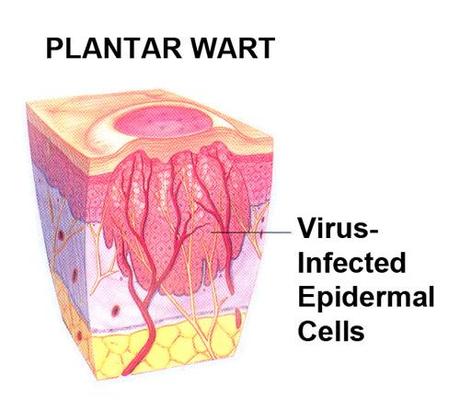 How to Treat, Cure and Prevent Plantar Warts at Home - Kids' Foot Health