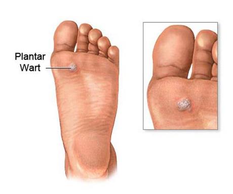 How to Treat, Cure and Prevent Plantar Warts at Home - Kids' Foot Health
