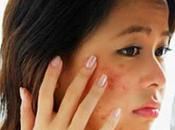 Troubleshoot None Your Acne Treatments Working