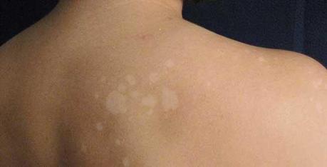 How can I remove white sun spots?