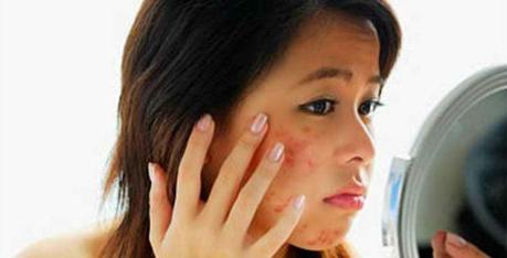 troubleshoot-acne-treatments-not-working-1