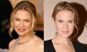 renee-zellweger-before-and-after-botox