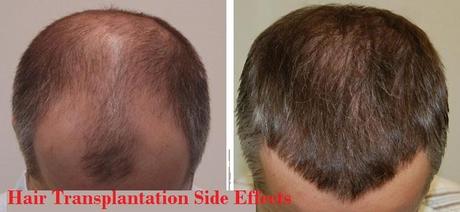 Hair Transplantation side effects