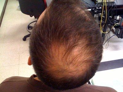 DHT Hair Loss prevention