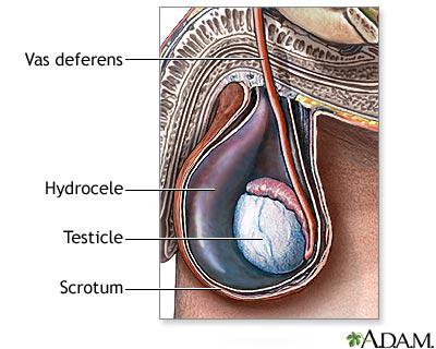 You Got To Know About Hydrocele!