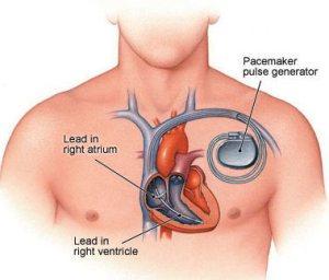 Heart-039-s-Natural-Pacemaker-2