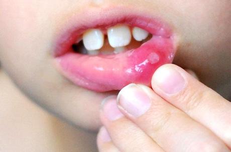 10 Home remedies for mouth ulcers