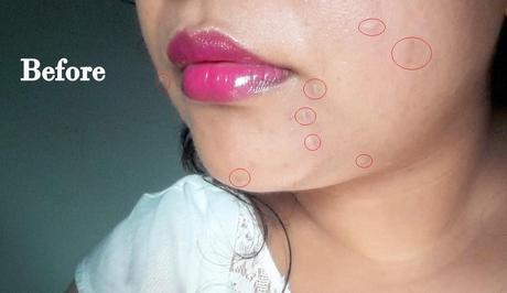 How I got Rid of Pimples | My Current Skincare Routine