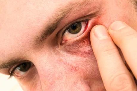 5 Ways to get rid of a stye