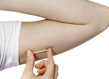 Nexplanon contraceptive implant