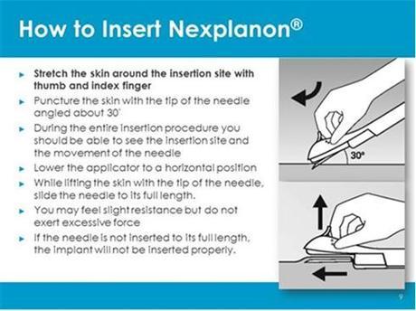 Nexplanon1
