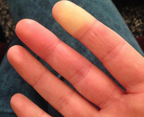 Health - Raynauds Disease