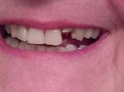 Lesson 1212 Disguise Broken Tooth