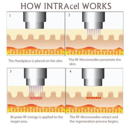 intracel how it works