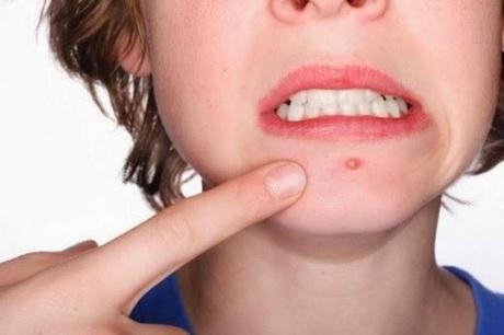 Get rid of a recurring pimple with the best acne treatment