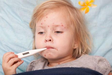 Symptoms of Chickenpox