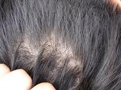 Having Dandruff Cause Hair Loss: Facts Information