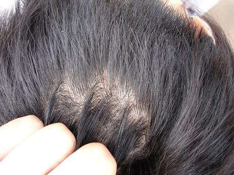 Can Having Dandruff Cause Hair Loss: Facts and Information - Paperblog