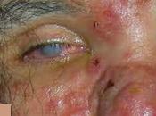 Syphilis Outbreak Among West Coast Homosexuals Leads Blindness